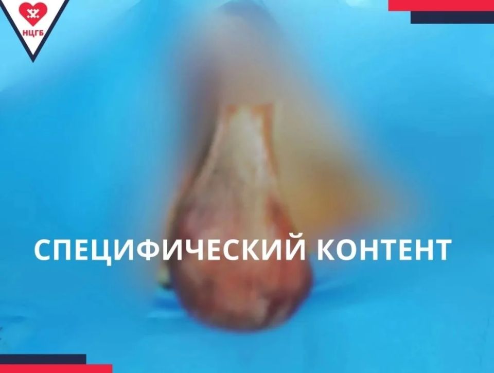 Врачи Новоуренгойской больницы удалили объёмную липому Врачи Новоуренгойской больницы удалили объёмную липому
