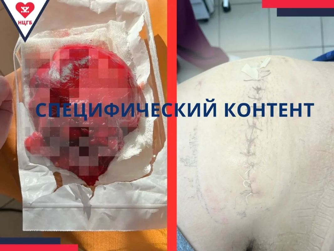 В Новом Уренгое хирурги удалили гигантскую липому размером 1510 см. Доброкачественное образование правого бедра диагностировали у 50-летнего мужчины